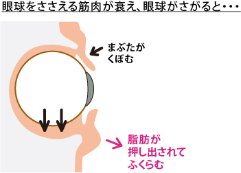 眼球がさがると