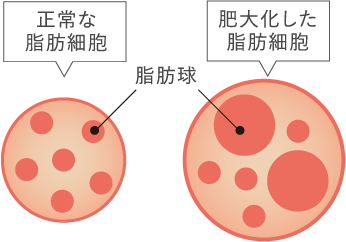 正常な脂肪細胞と肥大化した脂肪細胞