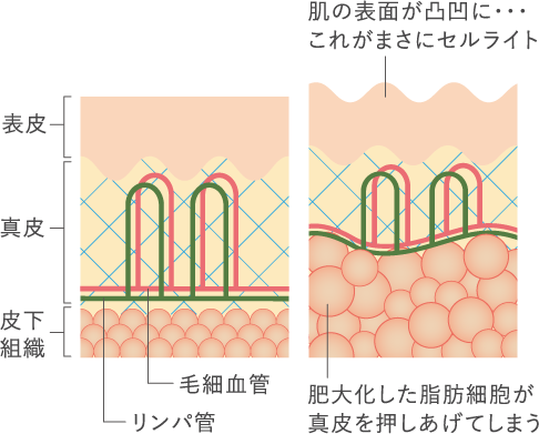 肥大化した脂肪細胞が真皮を押しあげてしまい、肌の表面が凸凹に・・・。これがまさにセルライト